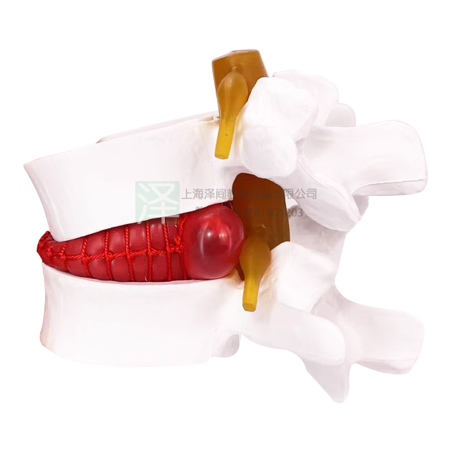 腰椎间盘突出演示模型