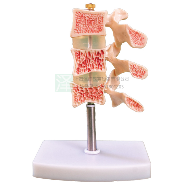 脊椎典型病变模型